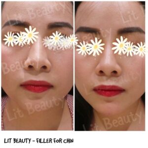 Tiêm Filler cằm thon gọn